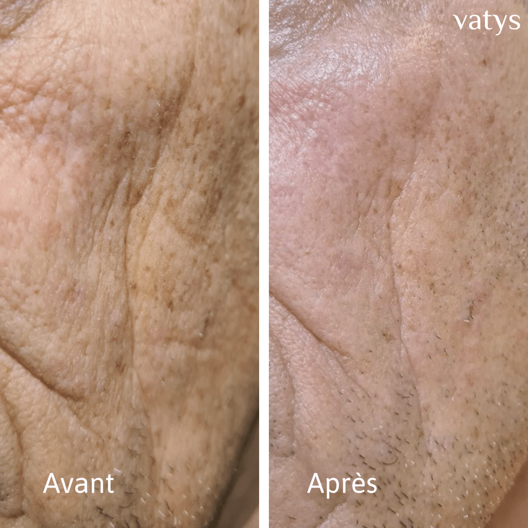 Comment réduire les rides du visage et lisser la peau naturellement