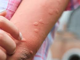 Piqûre de méduse : que faire pour apaiser la peau après une irritation