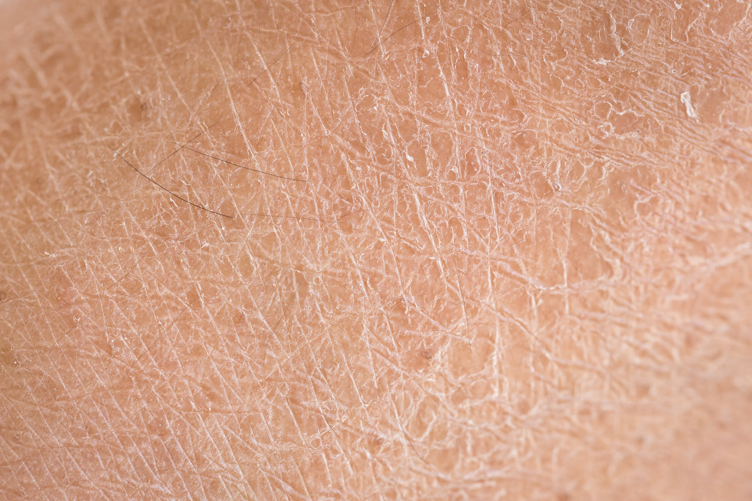 Peau sèche ou peau déshydratée : comprendre la différence et choisir les bons soins