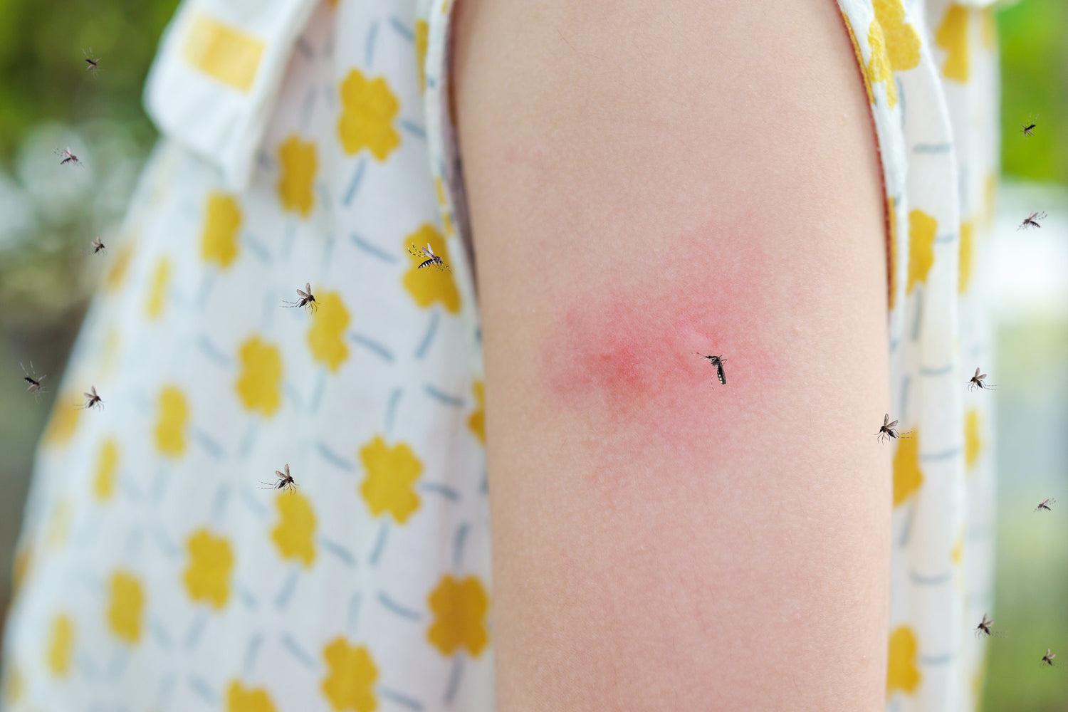 Piqûre de moustique : que faire pour apaiser la peau et limiter les démangeaisons