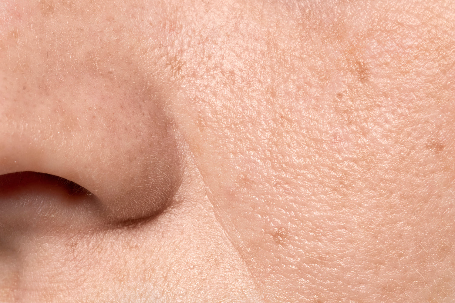 Pores dilatés : causes et solutions pour affiner le grain de peau
