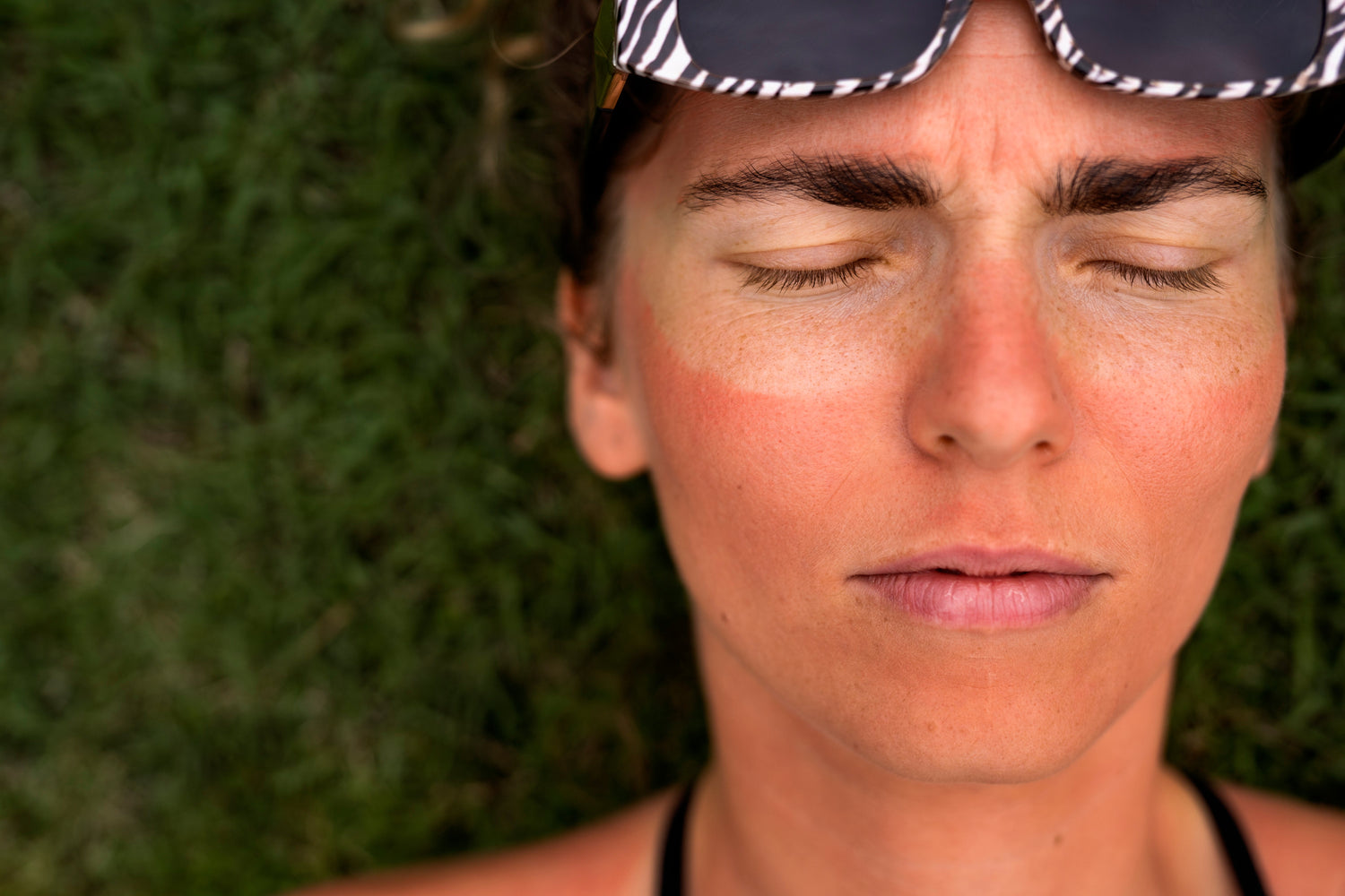 Coup de soleil sur peau sensible : comment apaiser rapidement et naturellement ?